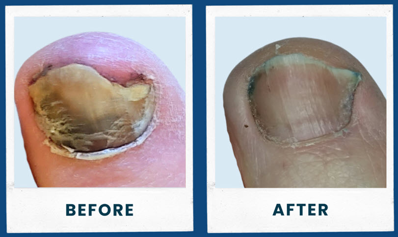 ToeFX-before and after ToeFX-before and after